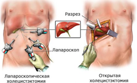 Холецистэктомия в Москве: современный метод лечения заболеваний желчного пузыря